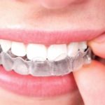 Елайнери Invisalign